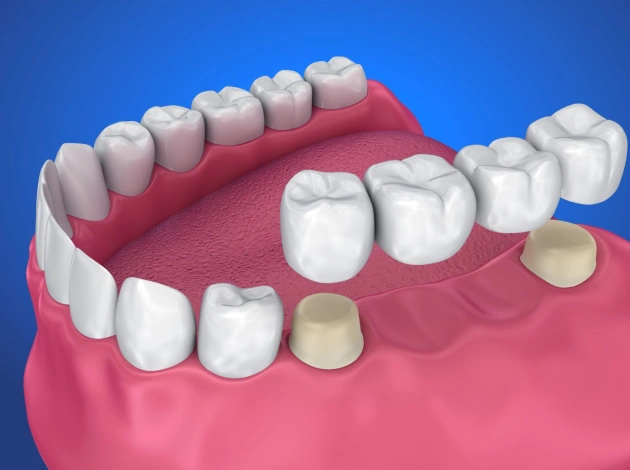 3D dental model showing teeth and gum structure with crowns and restorations on blue background.