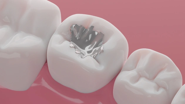 White tooth model showing dental filling procedure against pink background